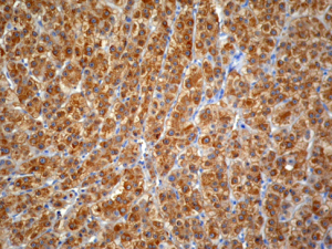 Hepatocarcinoma con expresión difusa de GS.