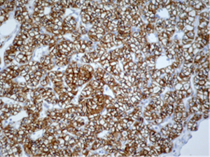 Carcinoma renal de células claras CAIX positivo